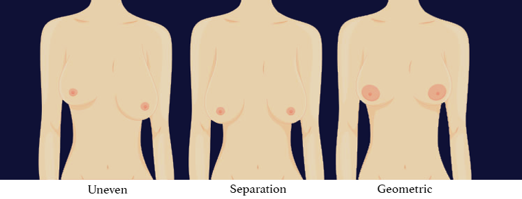 Can I Breastfeed After Different Types of Breast Surgery?